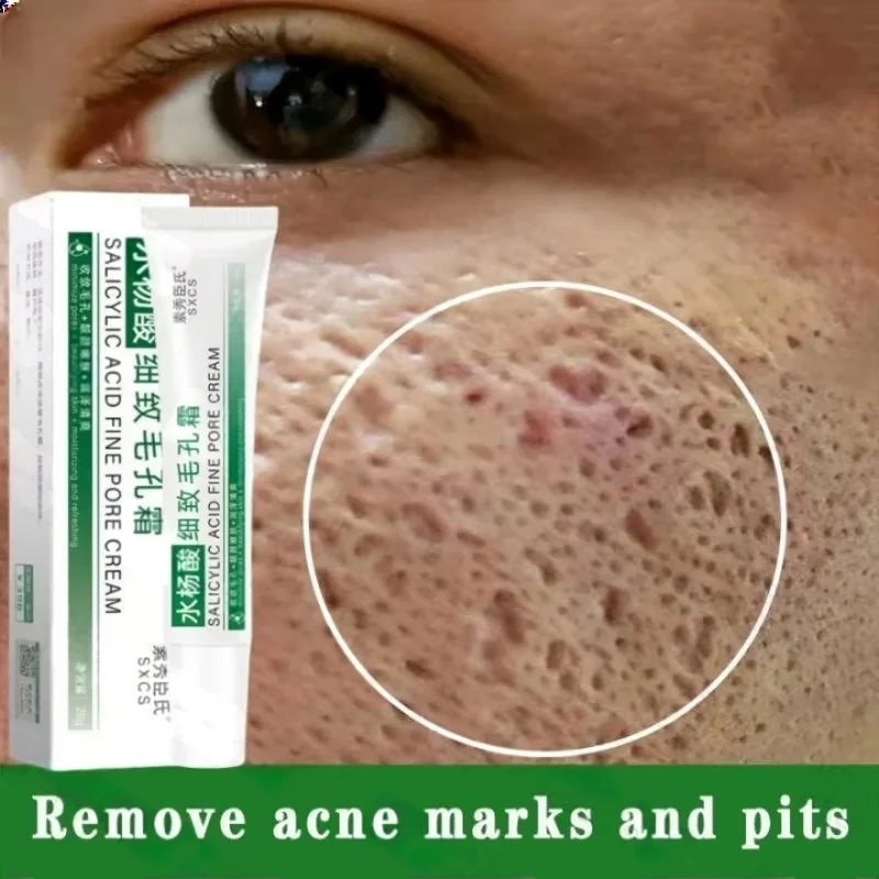 Krim Pembersih Pori Asam Salis - Azelaic Acid Cream ulasan dan harga